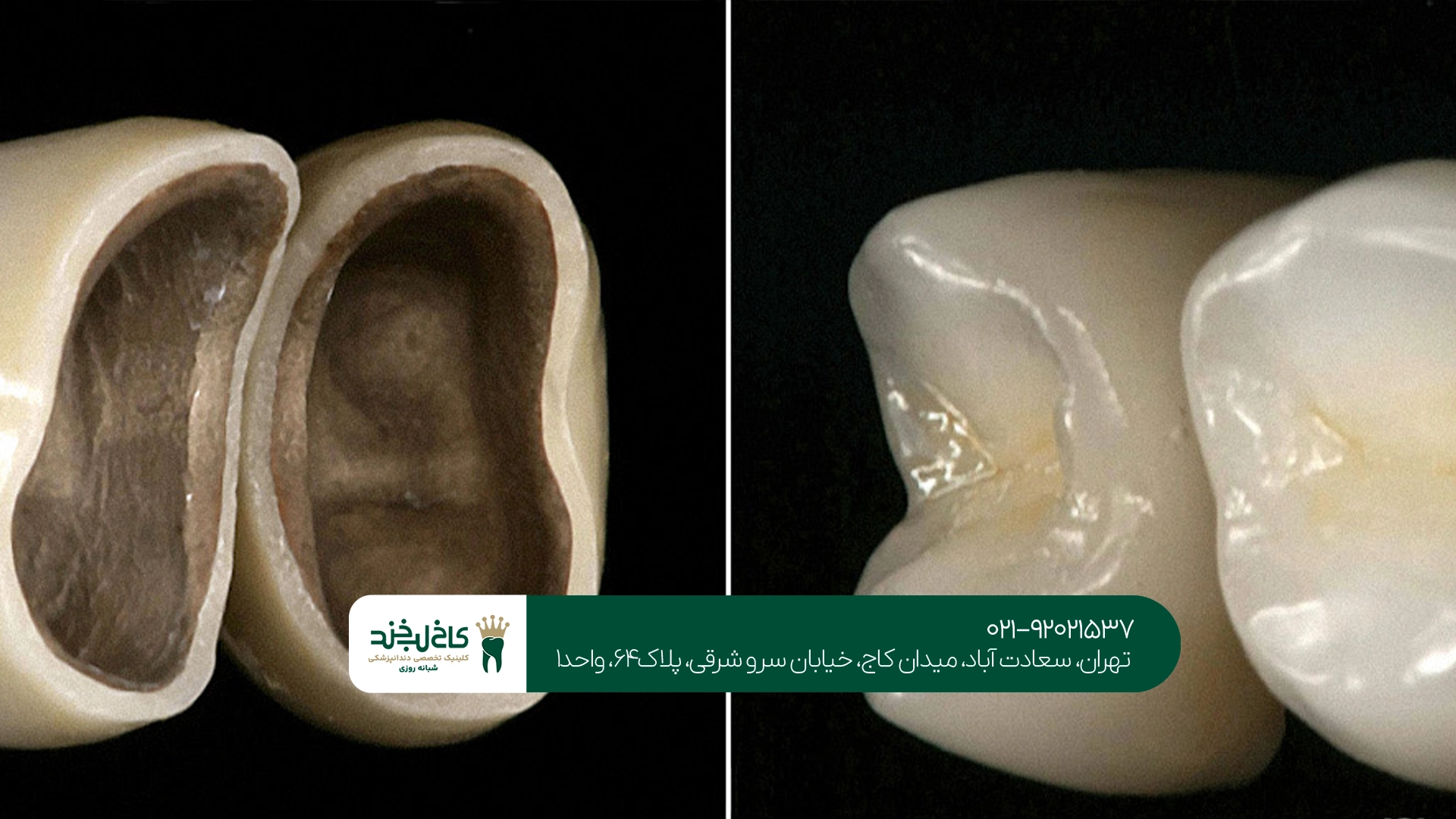 تفاوت روکش سرامیکی و فلزی دندان