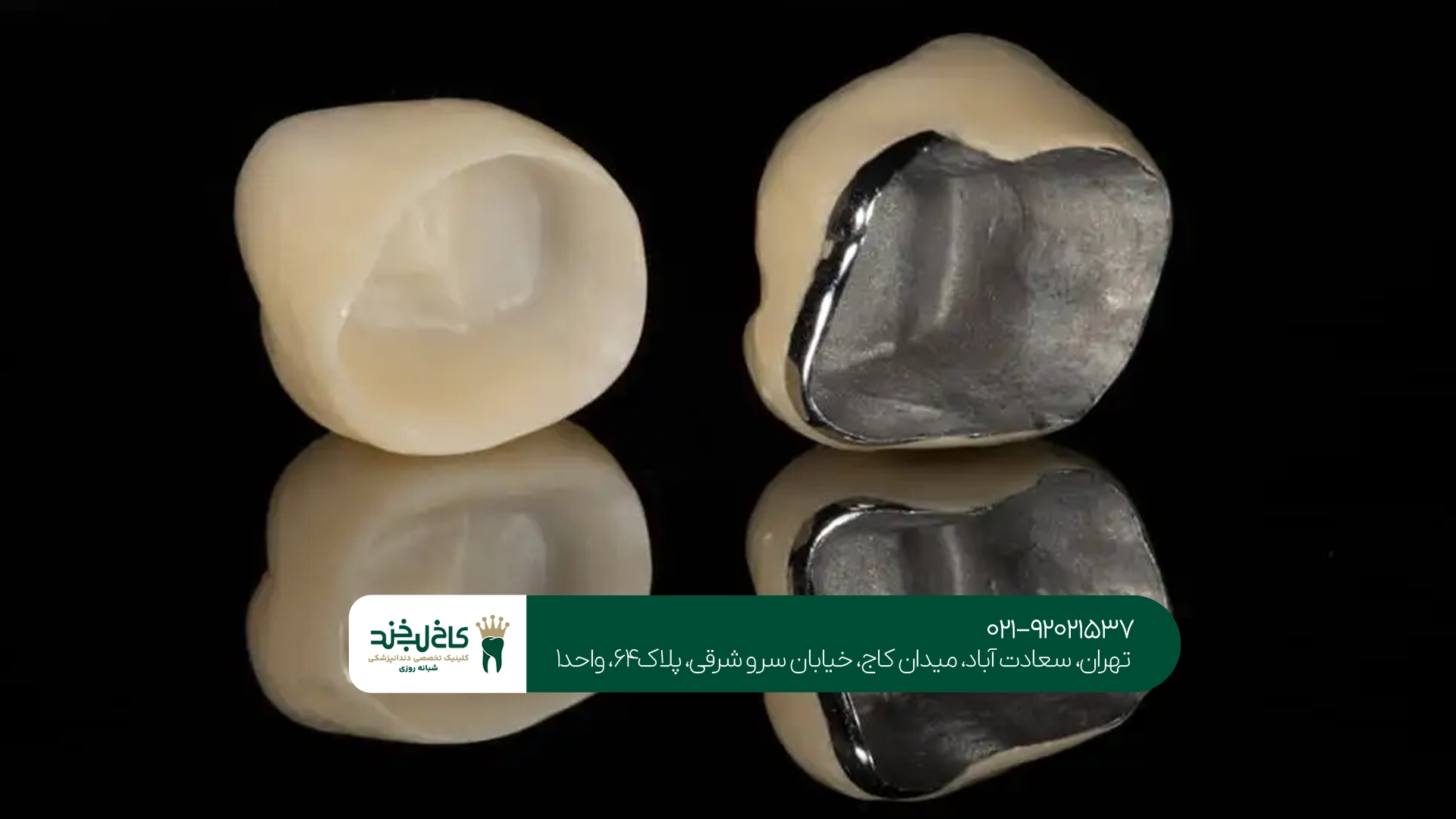 تفاوت طول عمر روکش سرامیکی و فلزی دندان