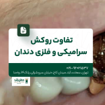 تفاوت روکش سرامیکی و فلزی دندان