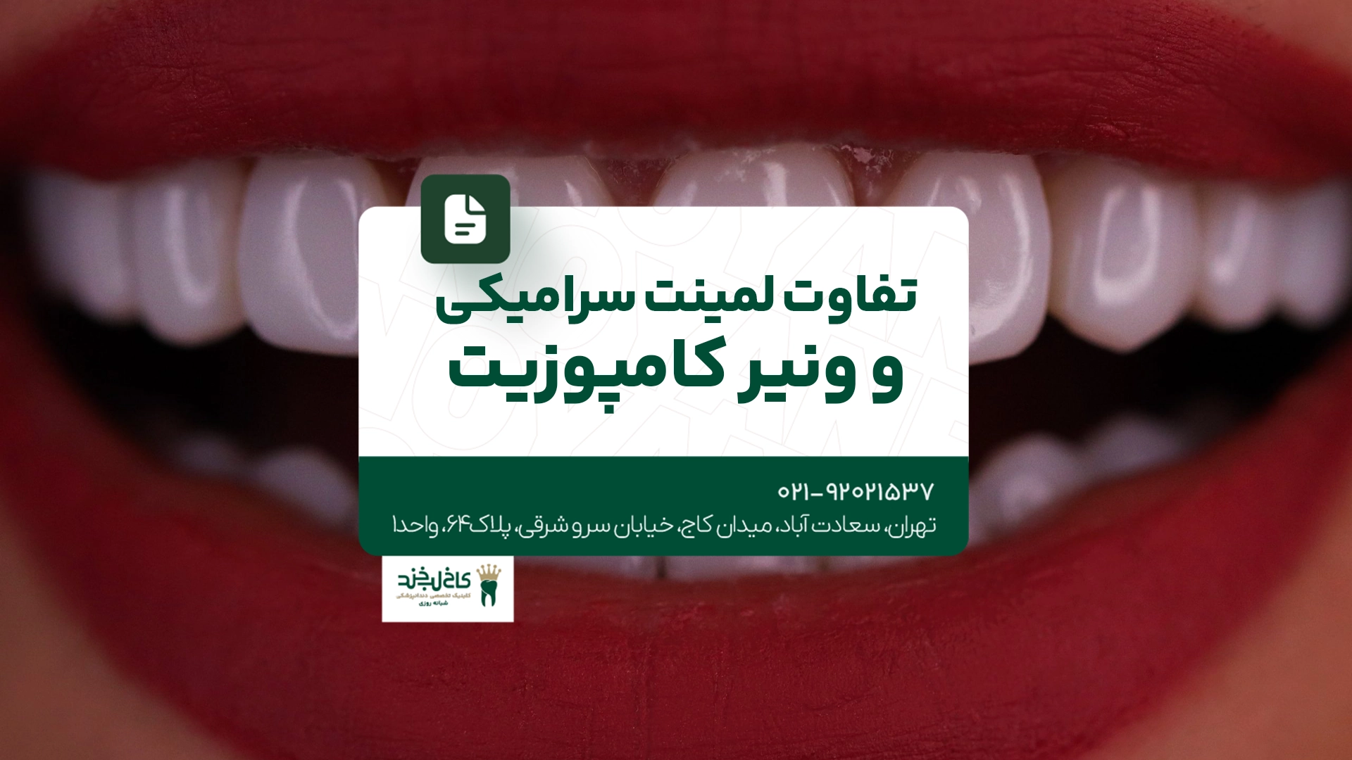 تفاوت لمینت سرامیکی و ونیر کامپوزیت