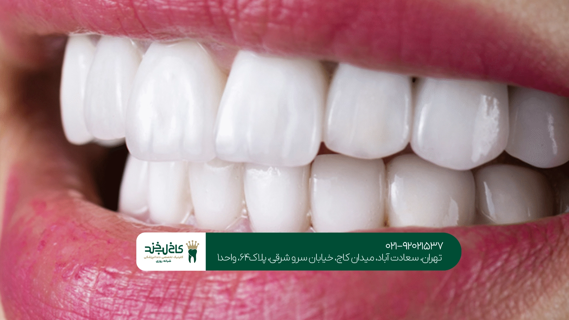 تفاوت مراحل انجام لمینت و ونیر کامپوزیت