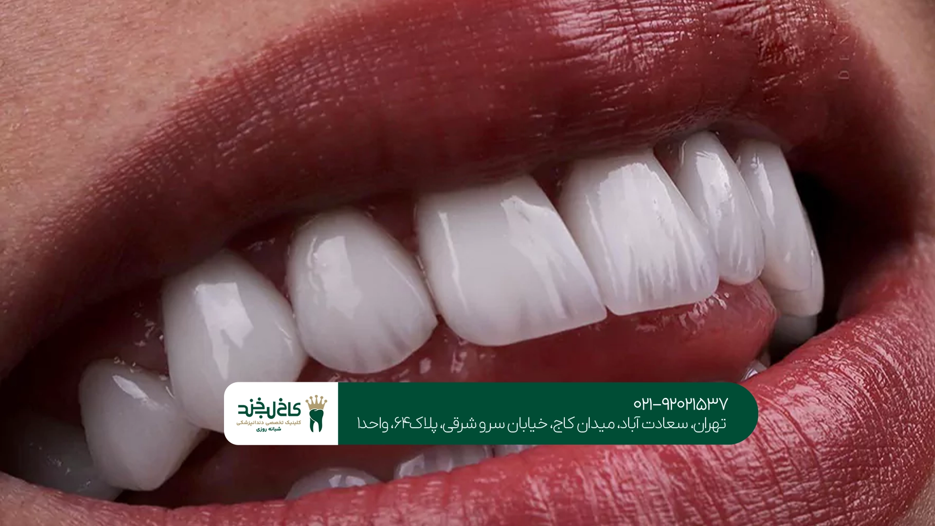 لمینت سرامیکی دندان