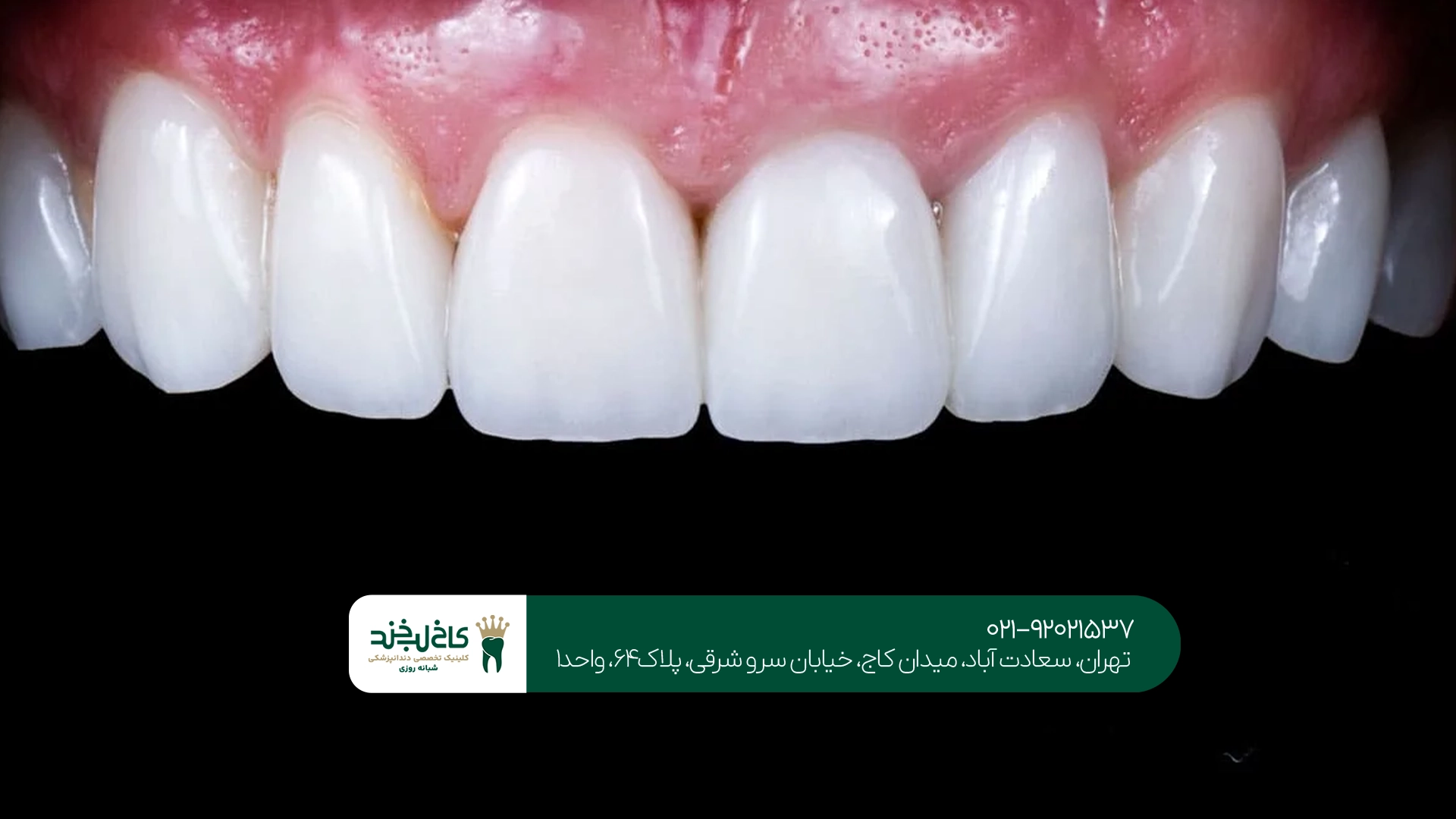 طراحی لبخند با لمینت و کامپوزیت