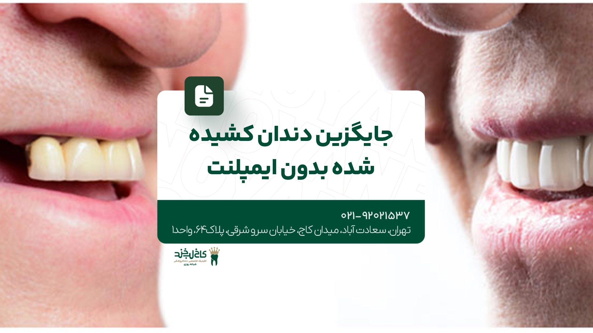 جایگزین دندان کشیده شده بدون ایمپلنت