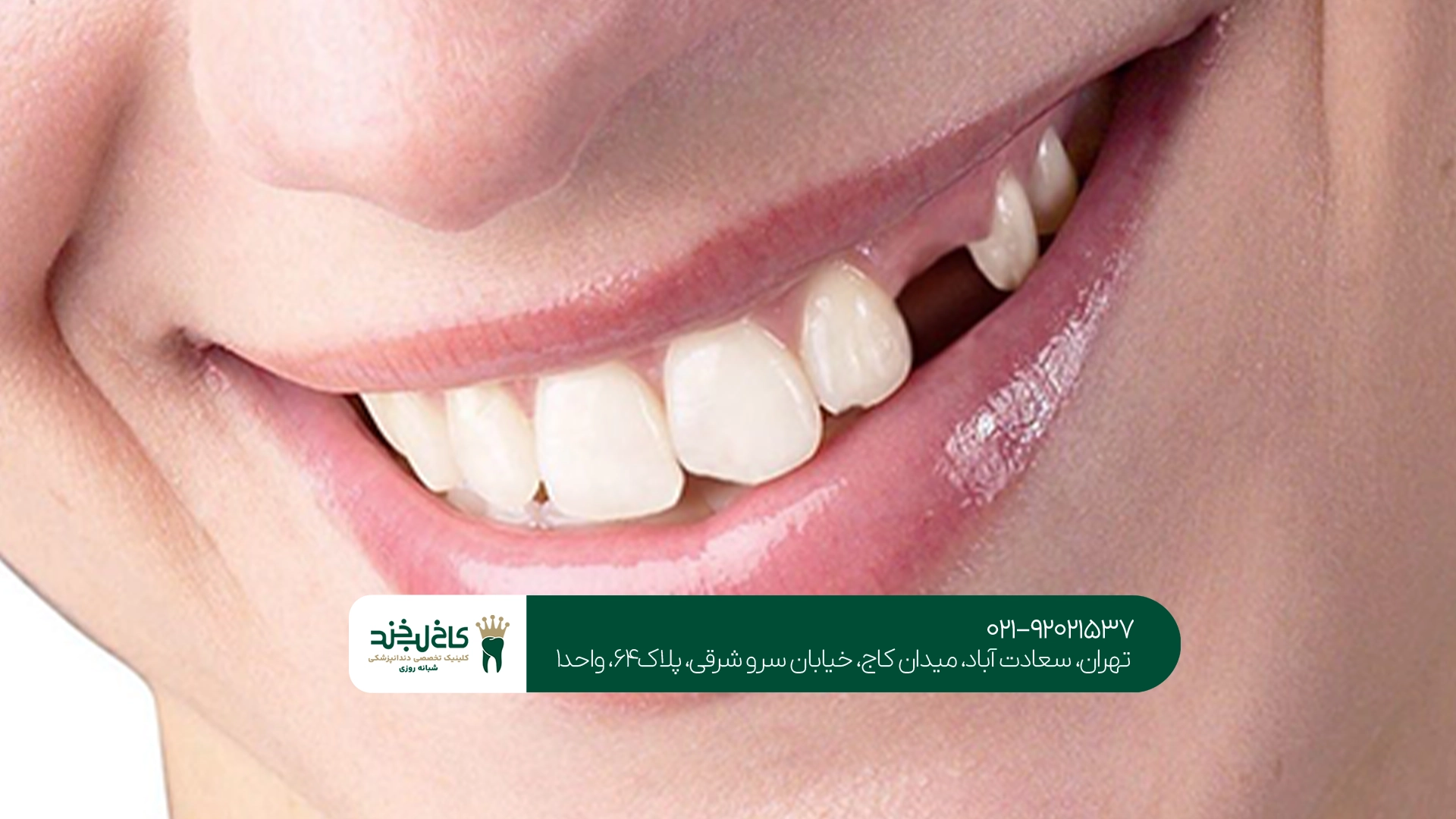 جایگزینی دندان بدون ایمپلنت
