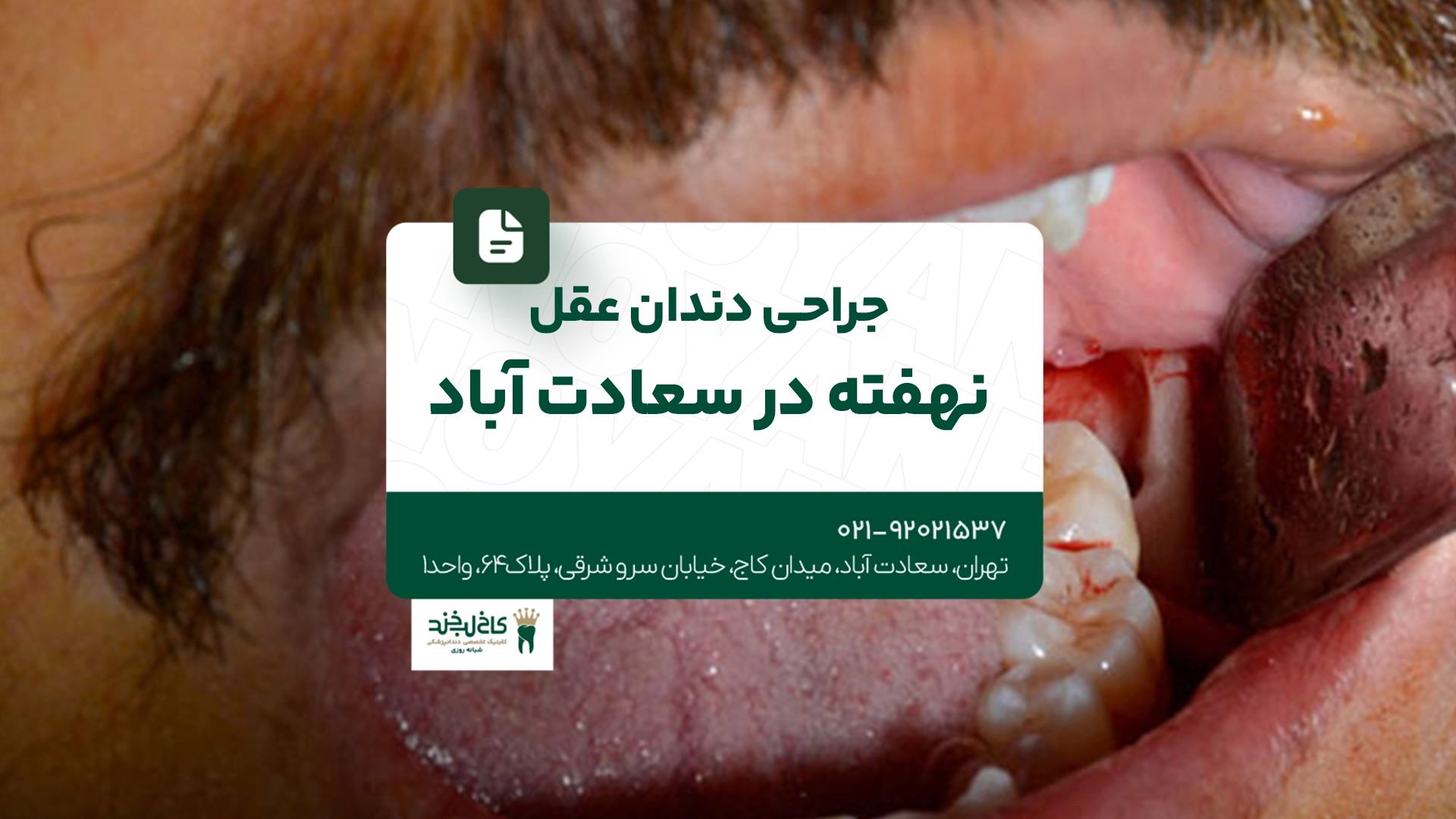 جراحی دندان عقل نهفته در سعادت آباد