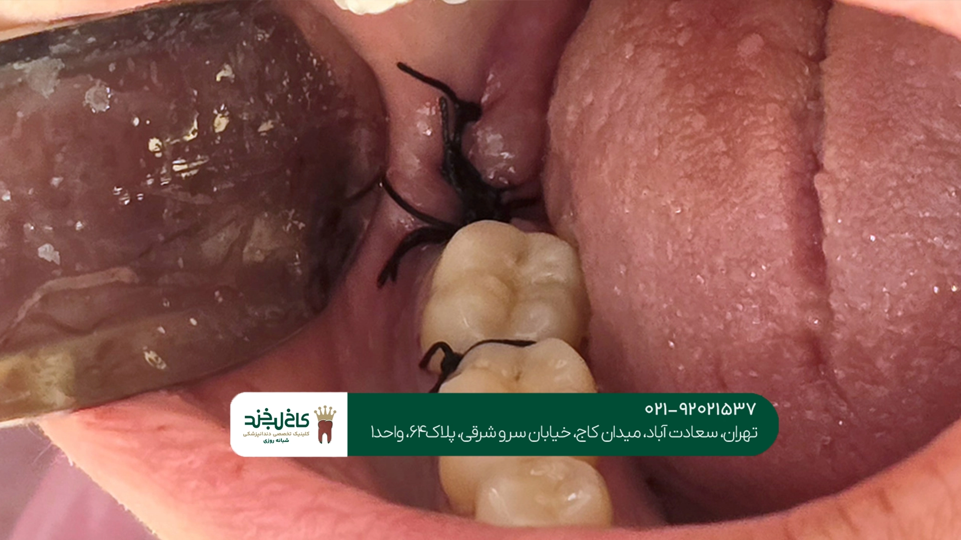 جراحی دندان عقل در تهران جراحی دندان عقل در تهران