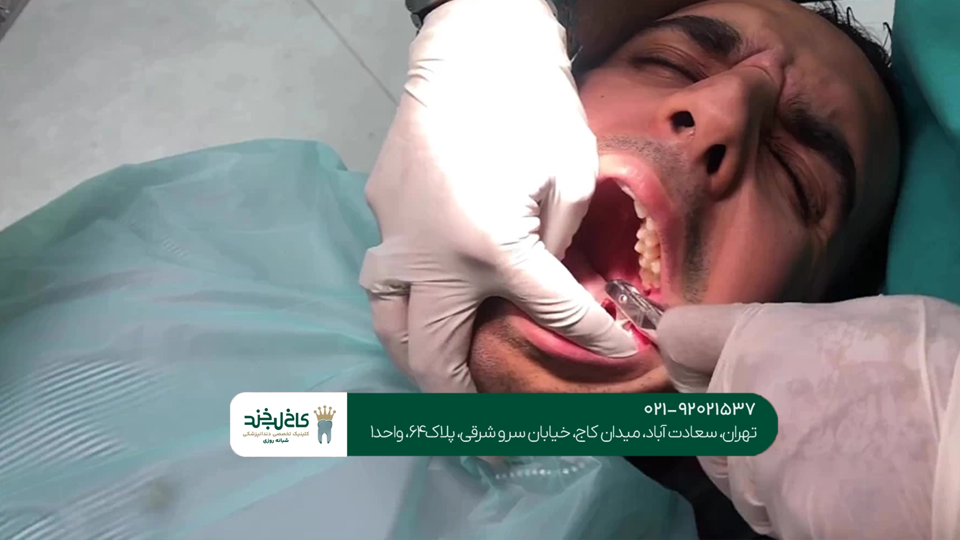 جراحی دندان عقل در تهران جراحی دندان عقل در تهران