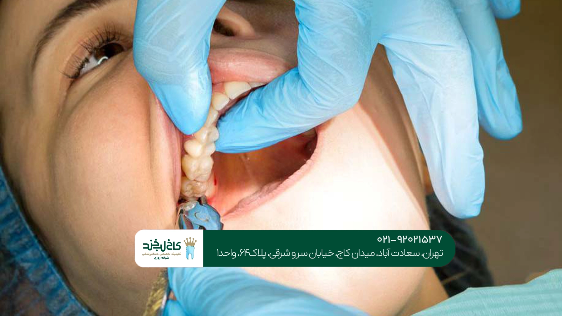 جراحی دندان عقل در تهران جراحی دندان عقل در تهران
