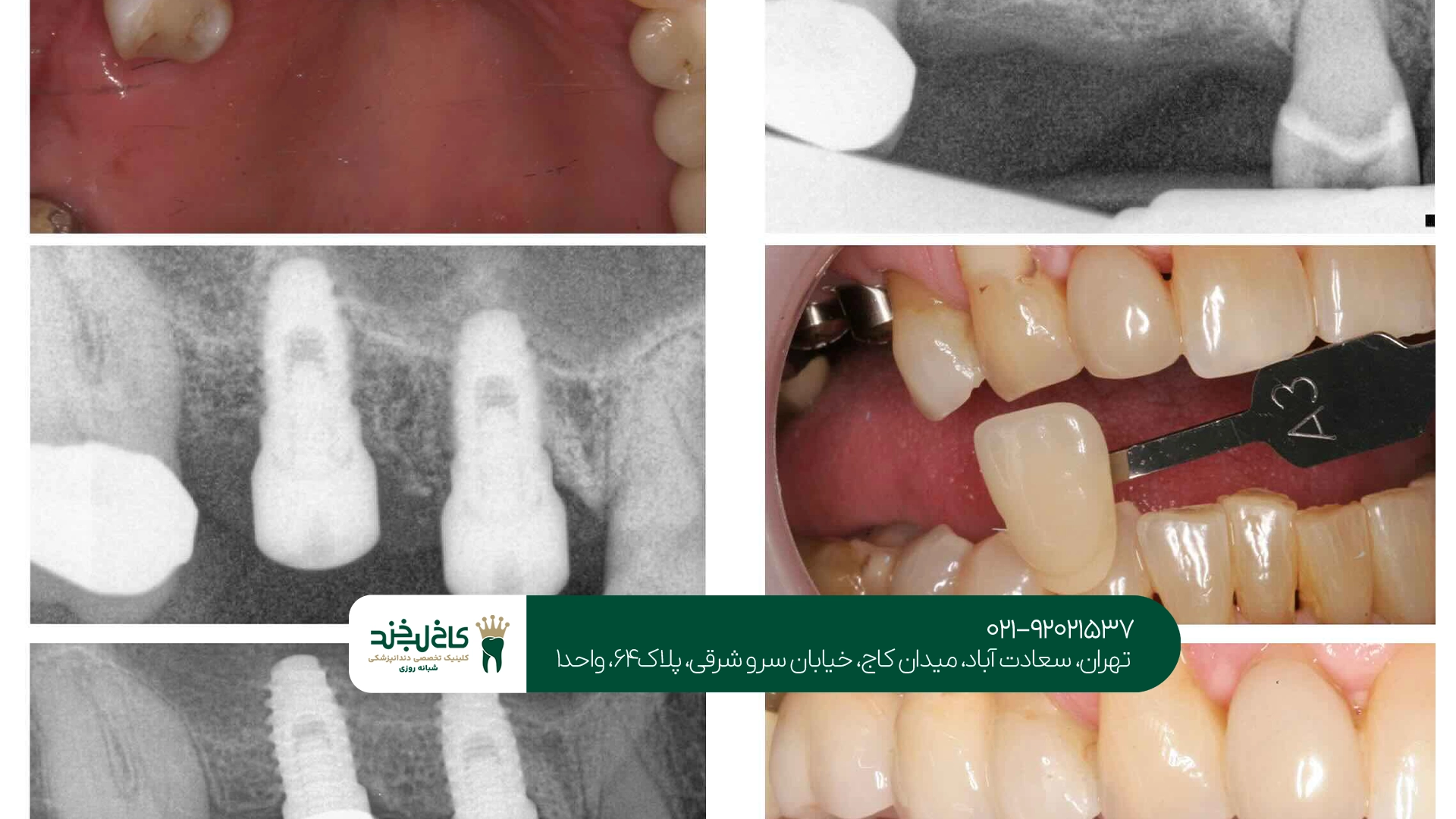 ایمپلنت دندان بدون سینوس لیفت امکان دارد؟