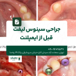 جراحی سینوس لیفت قبل از ایمپلنت