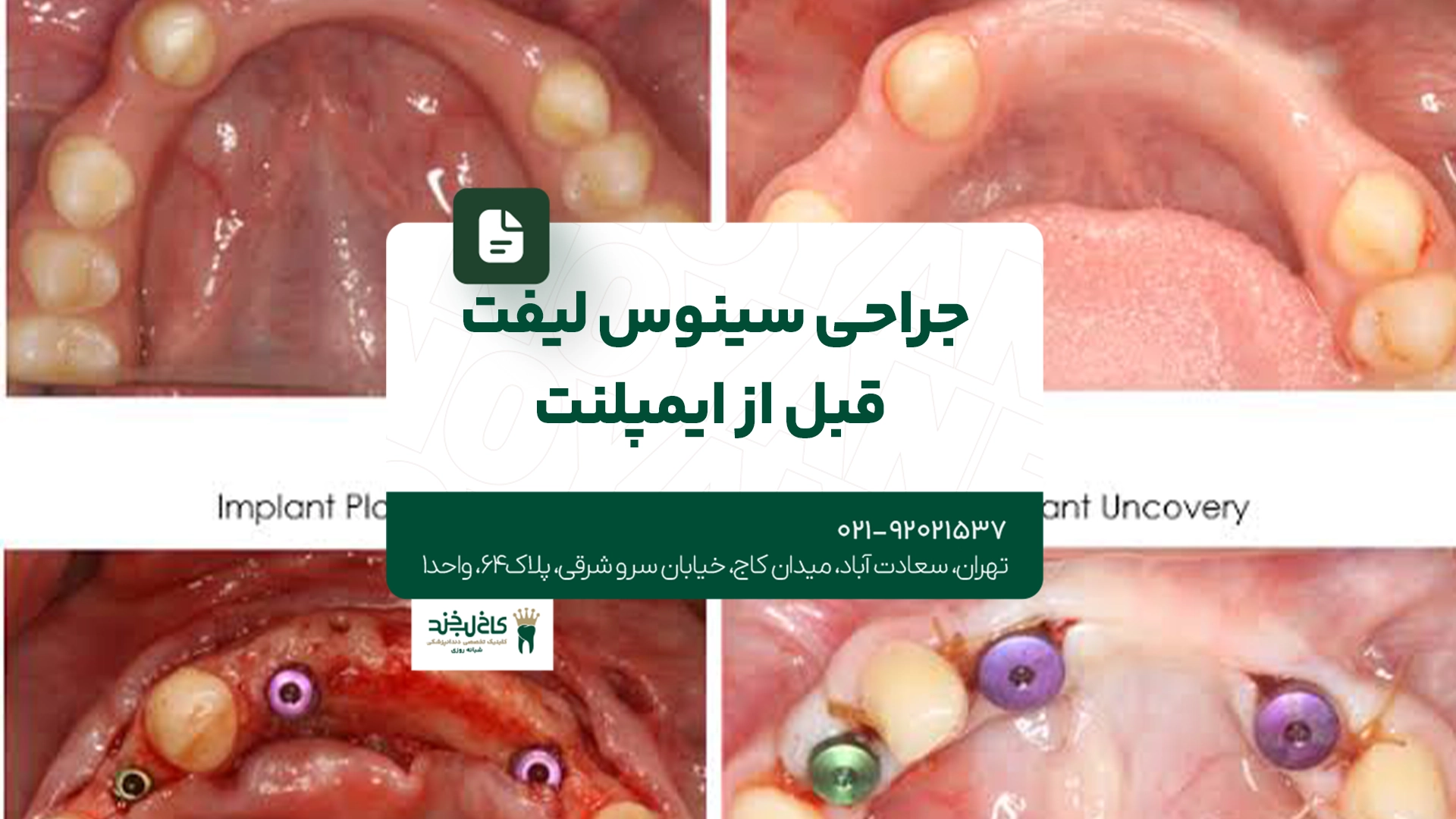 جراحی سینوس لیفت قبل از ایمپلنت