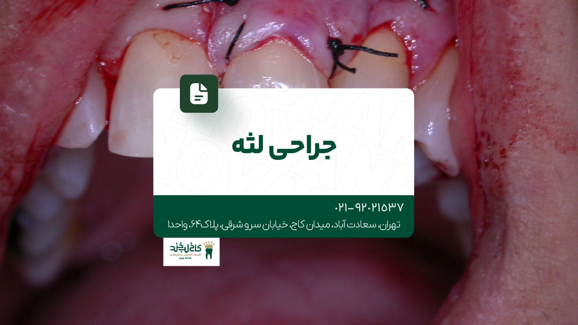 جراحی لثه جراحی لثه