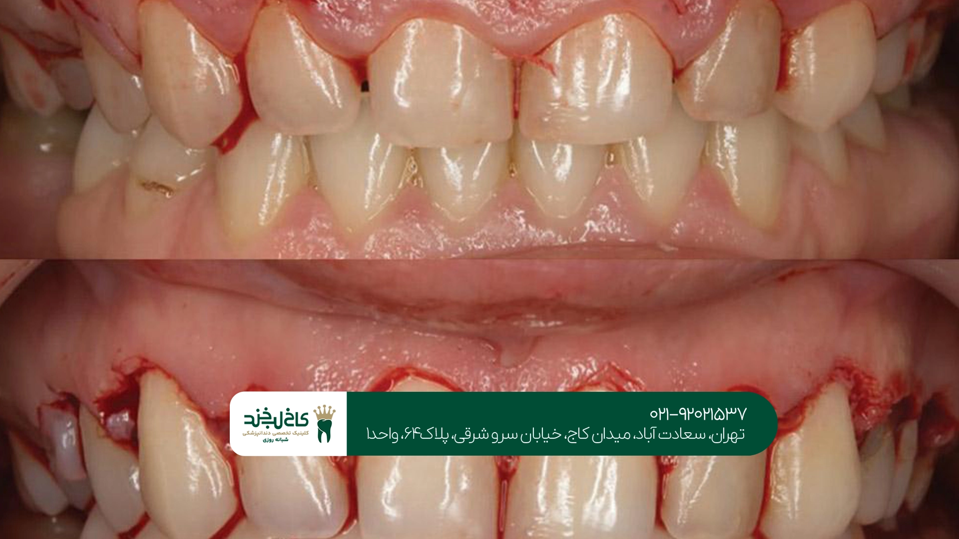 جراحی لثه در تهران جراحی لثه در تهران