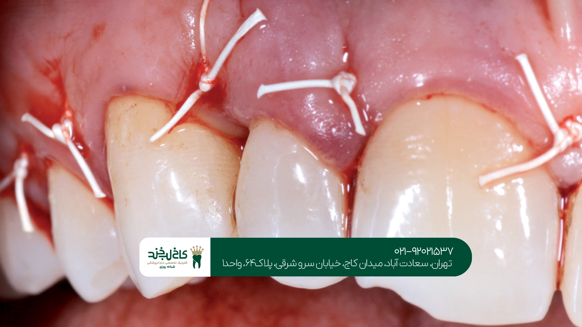 جراحی لثه در تهران جراحی لثه در تهران