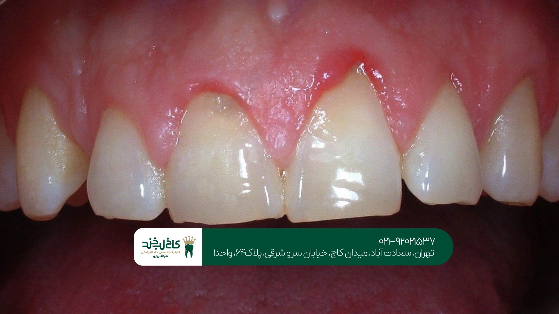 بهترین دندانپزشک تحلیل لثه