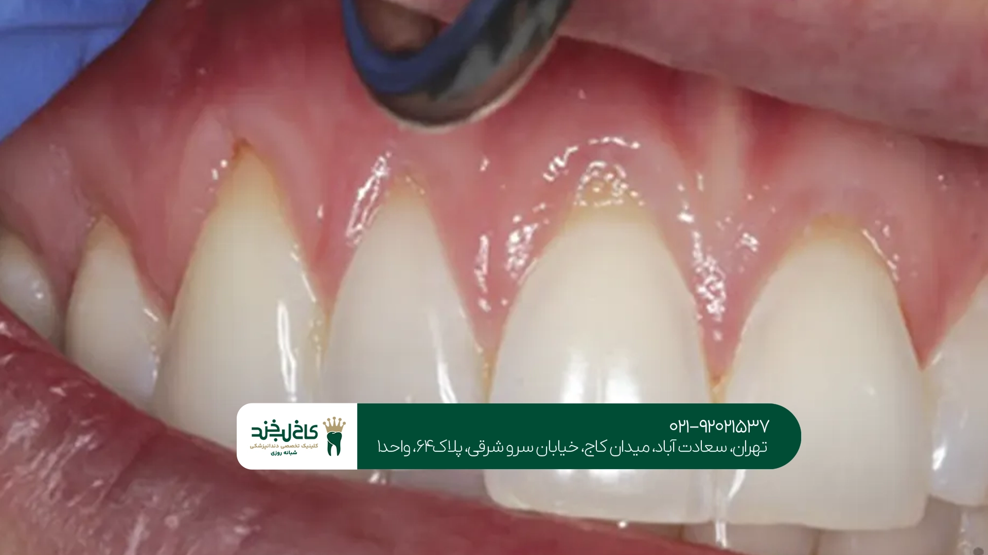 آیا تحلیل لثه قابل برگشت است؟