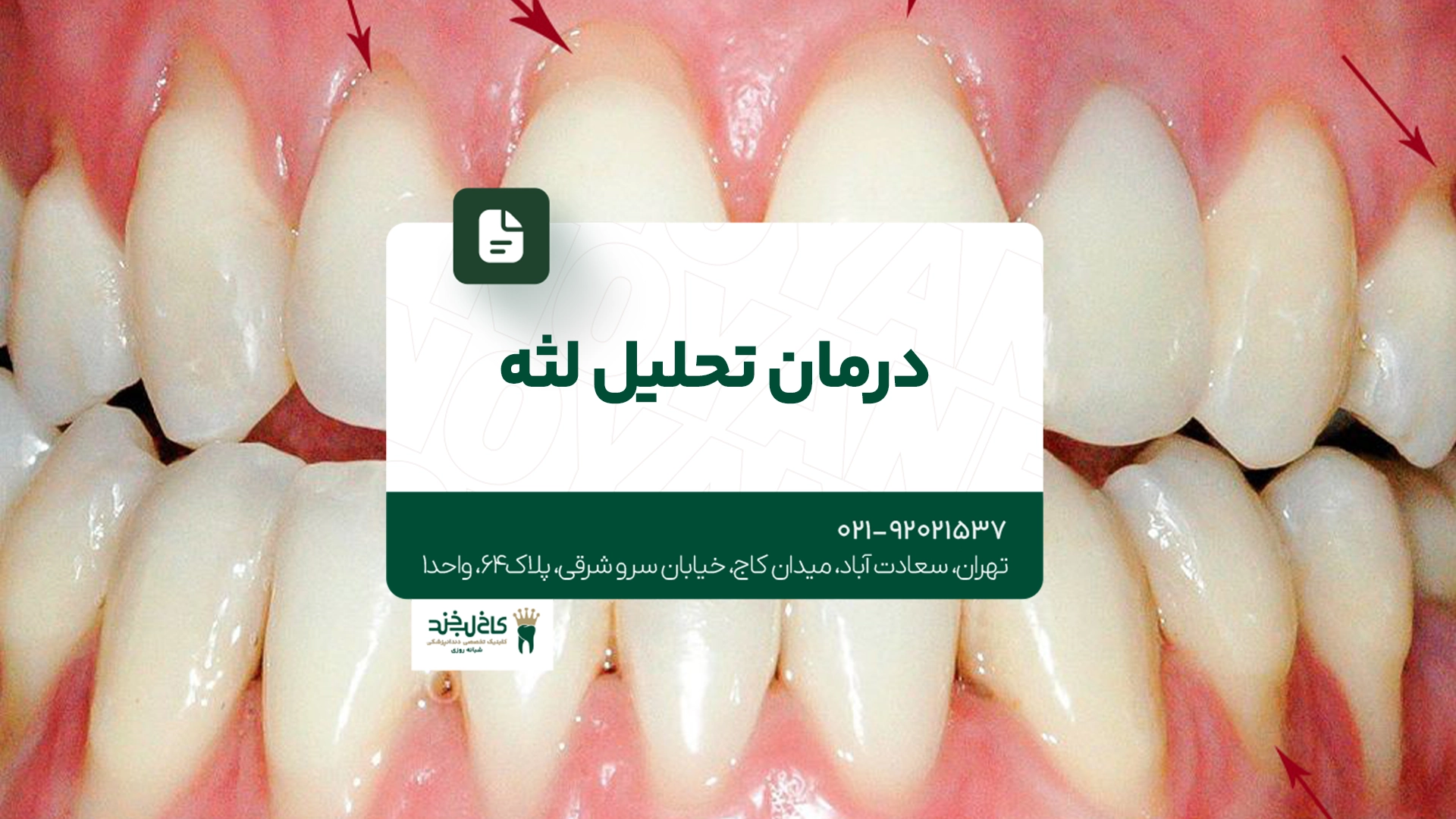 درمان تحلیل لثه