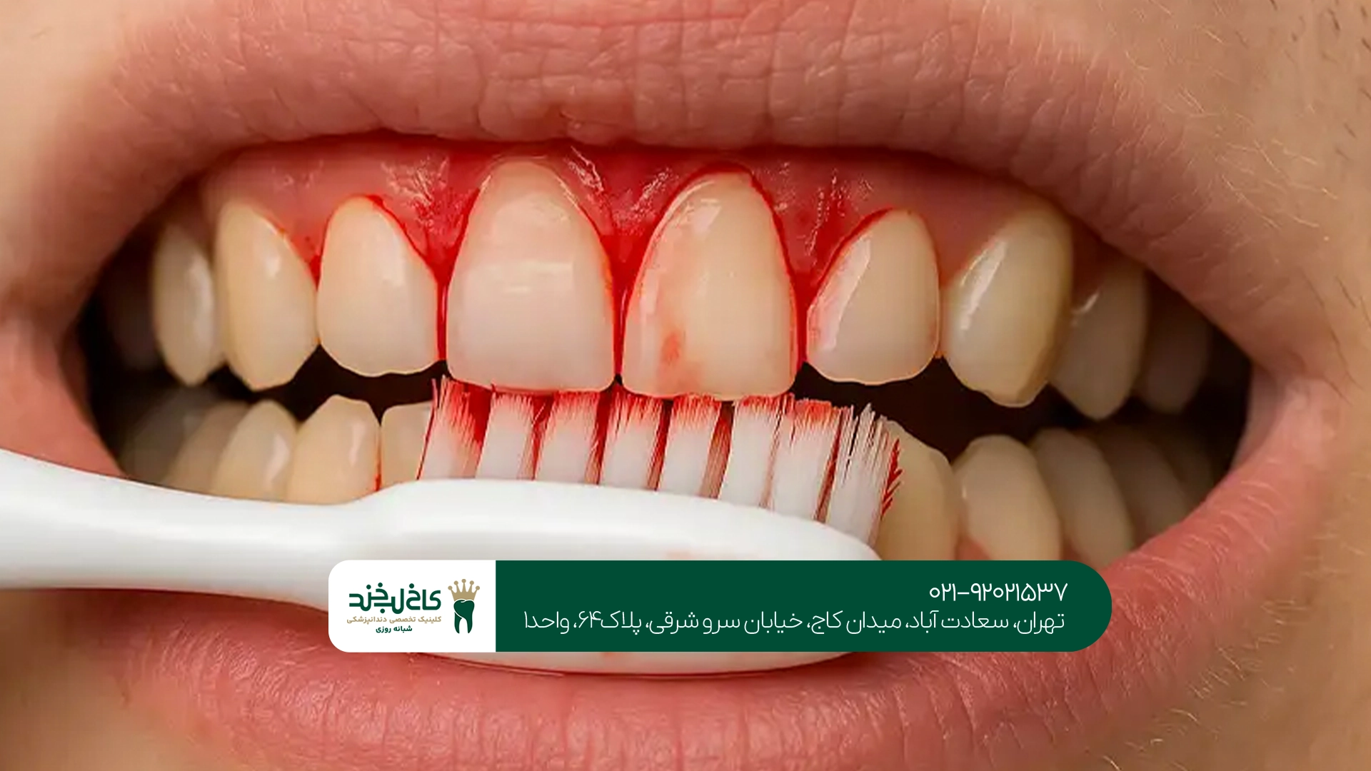 مسواک مناسب برای لثه حساس