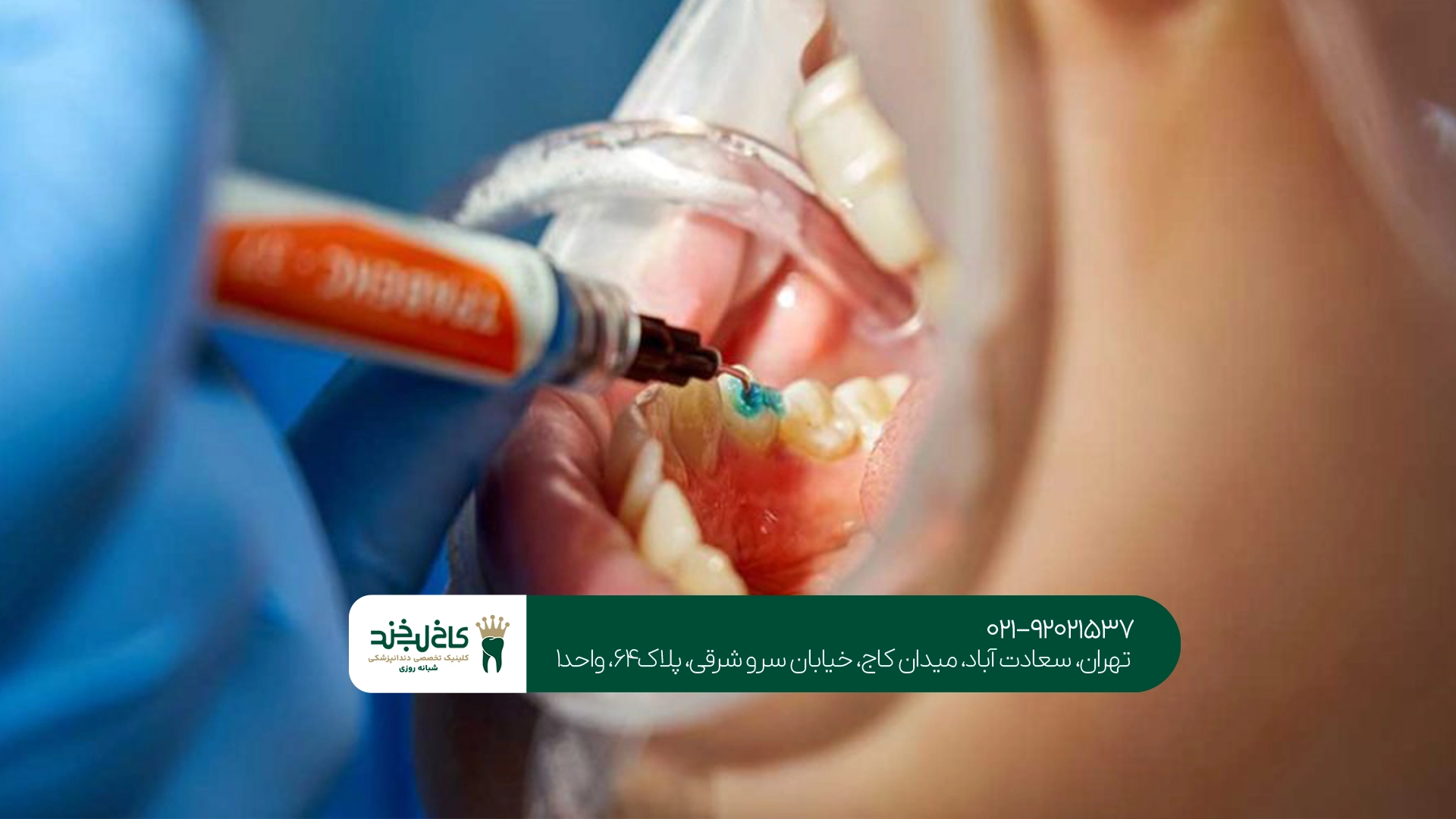 درمان دندان با بی حسی دیجیتال
