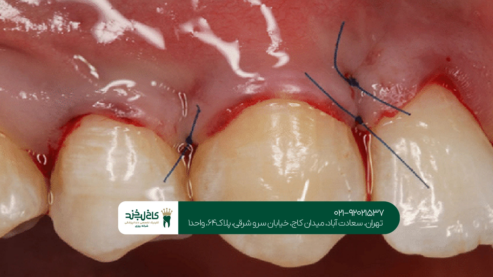 درمان تخصصی لثه