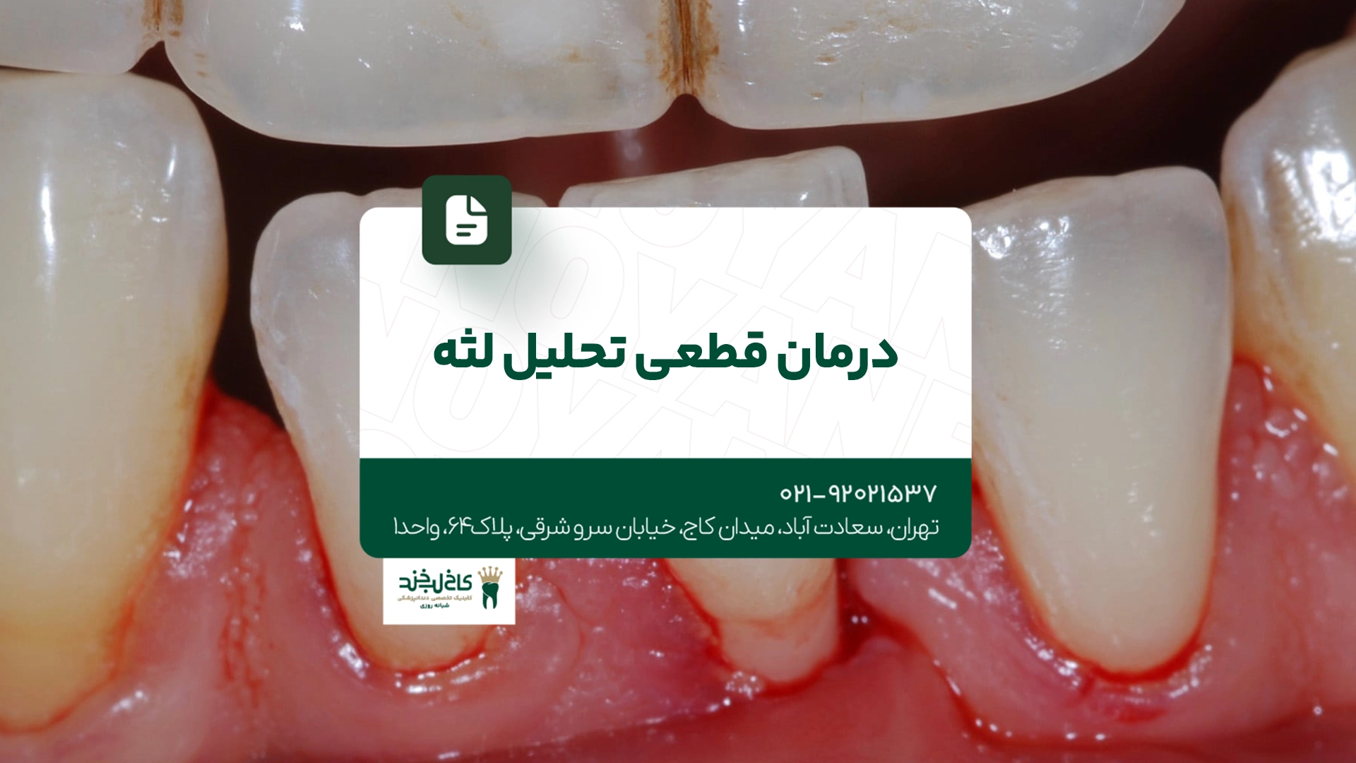 درمان قطعی تحلیل لثه