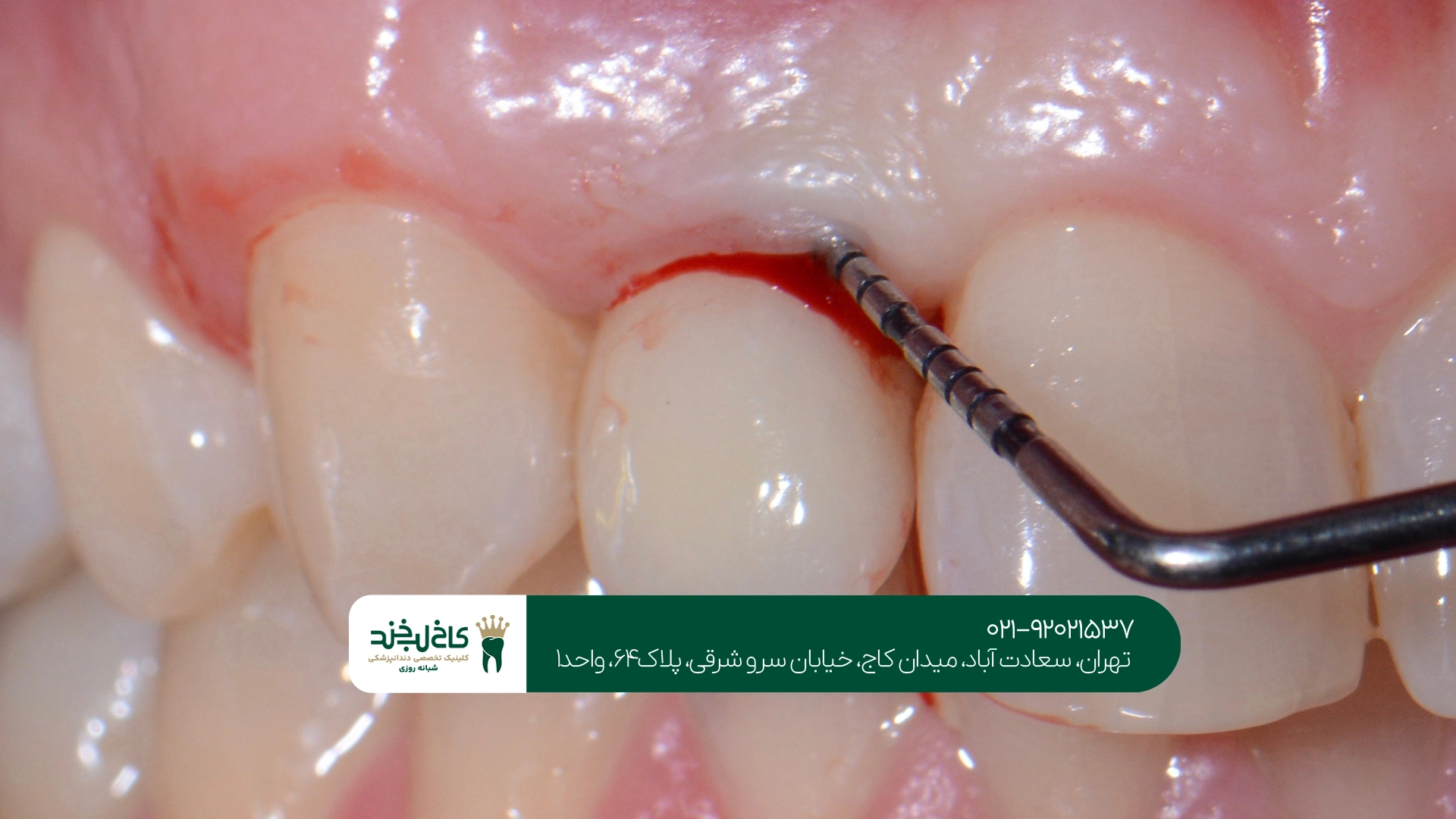 عوارض درمان نکردن تحلیل لثه چیست؟