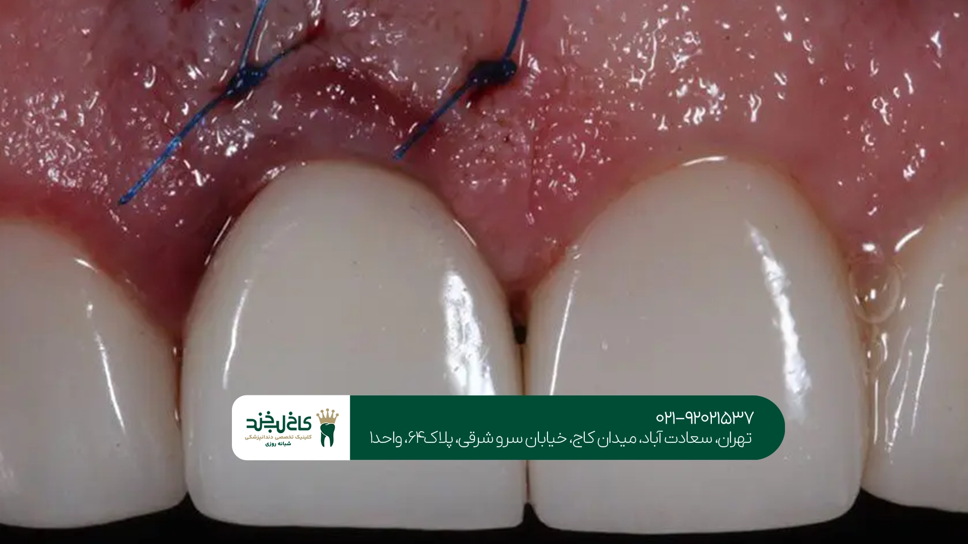 جدیدترین روشهای درمان تحلیل لثه