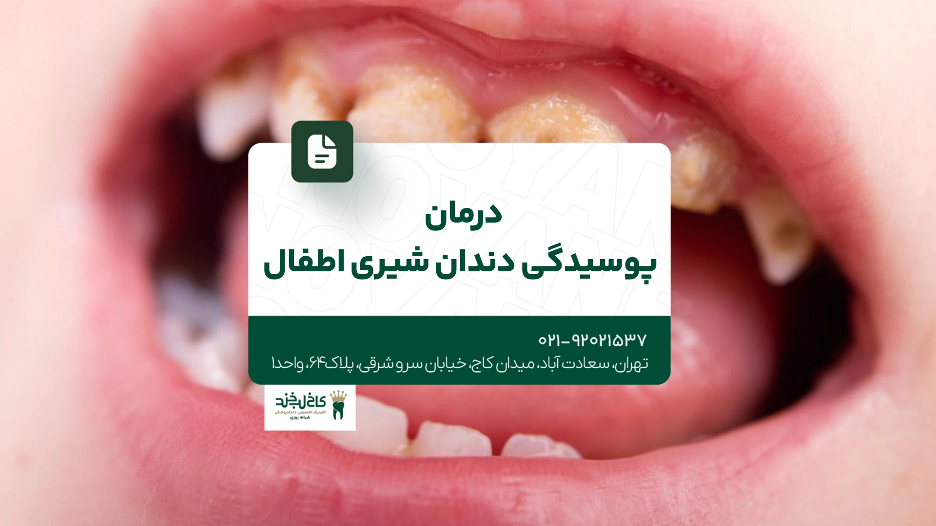 درمان پوسیدگی دندان شیری اطفال