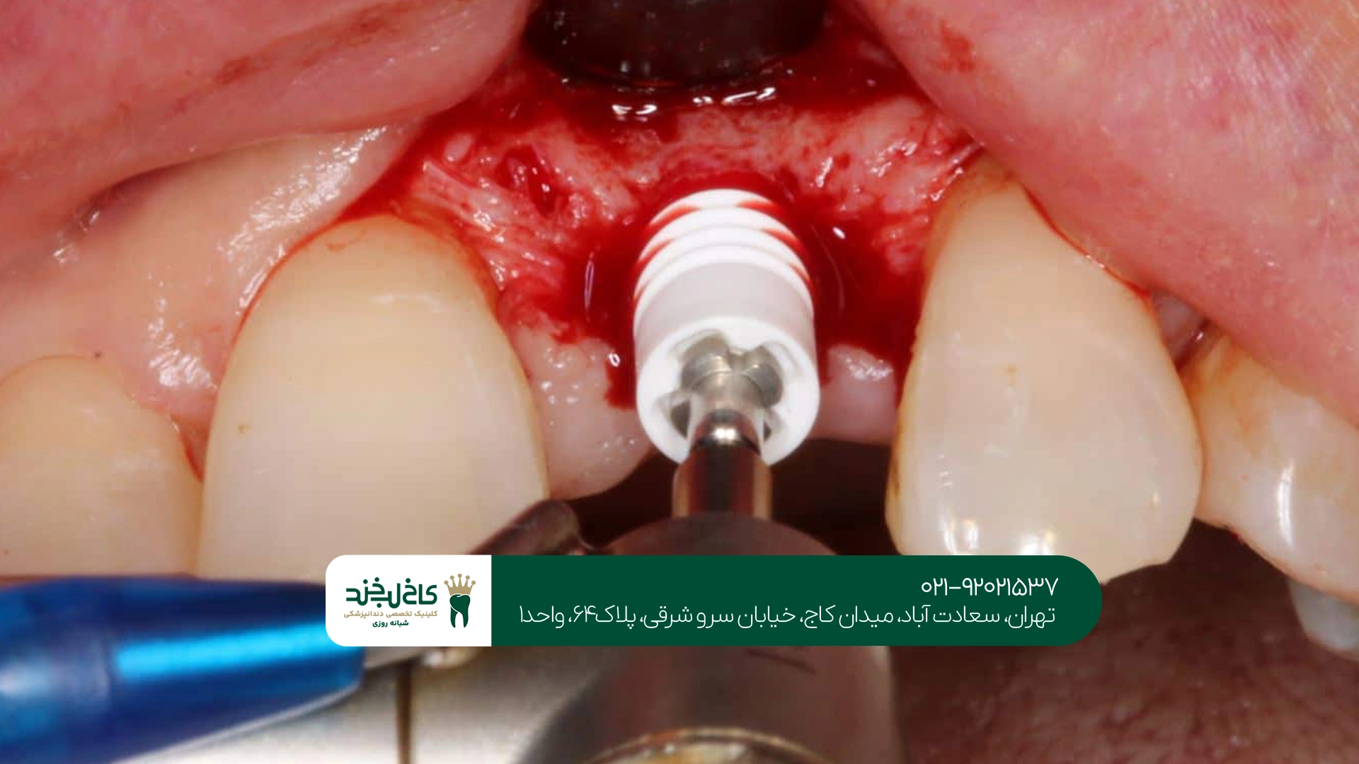 متخصص ایمپلنت دندان