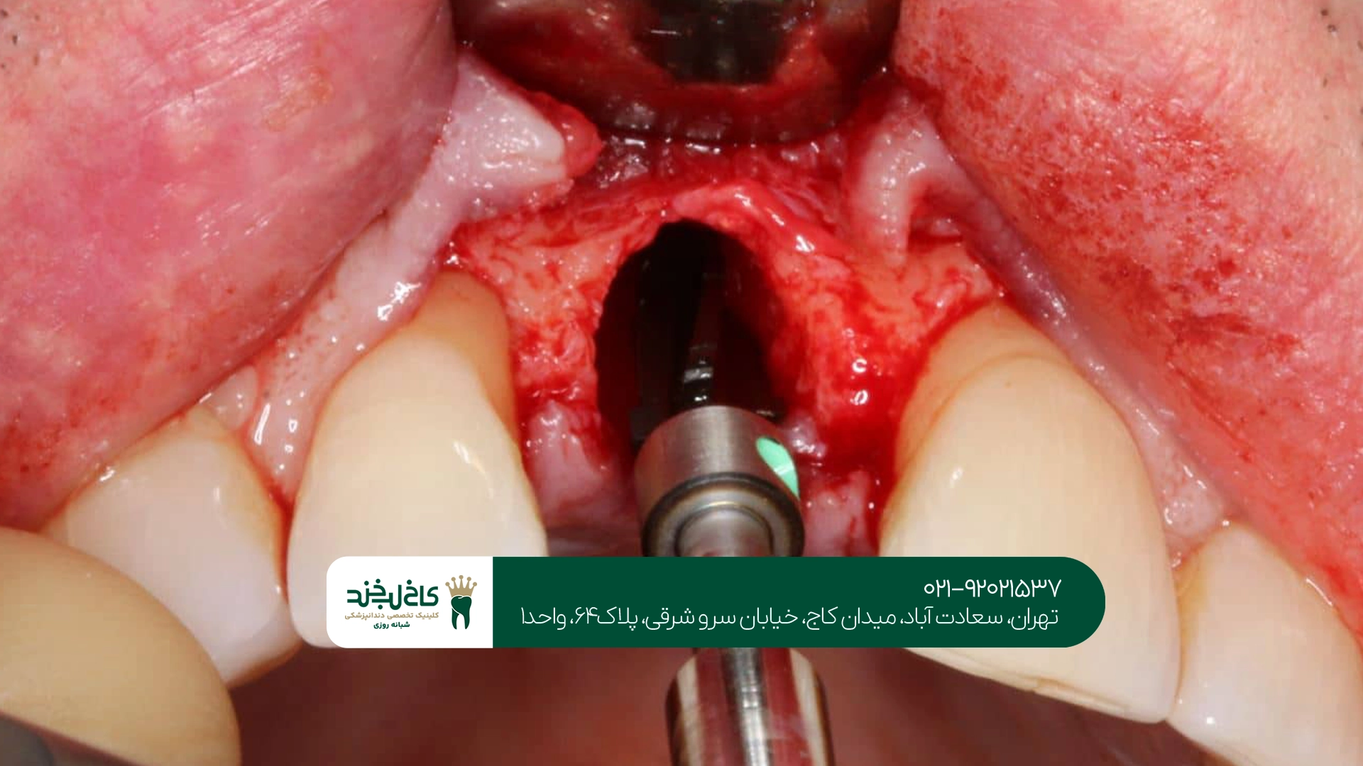ایمپلنت دندان فوری