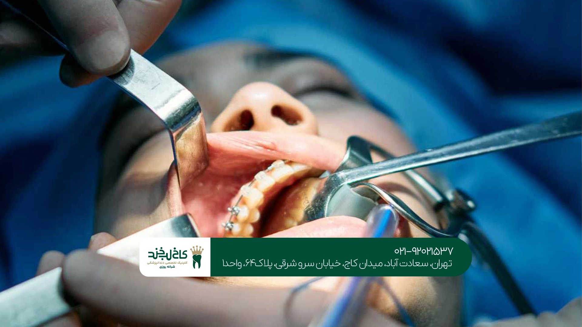 مراقبتهای بعد از جراحی دندان چیست؟