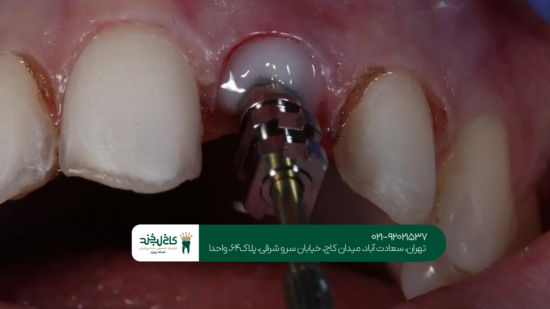 مرکز حرفهای کاشت دندان