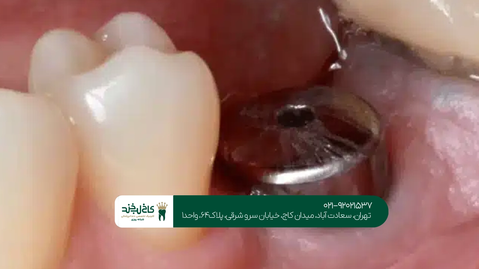 بهترین دکتر برای کاشت دندان