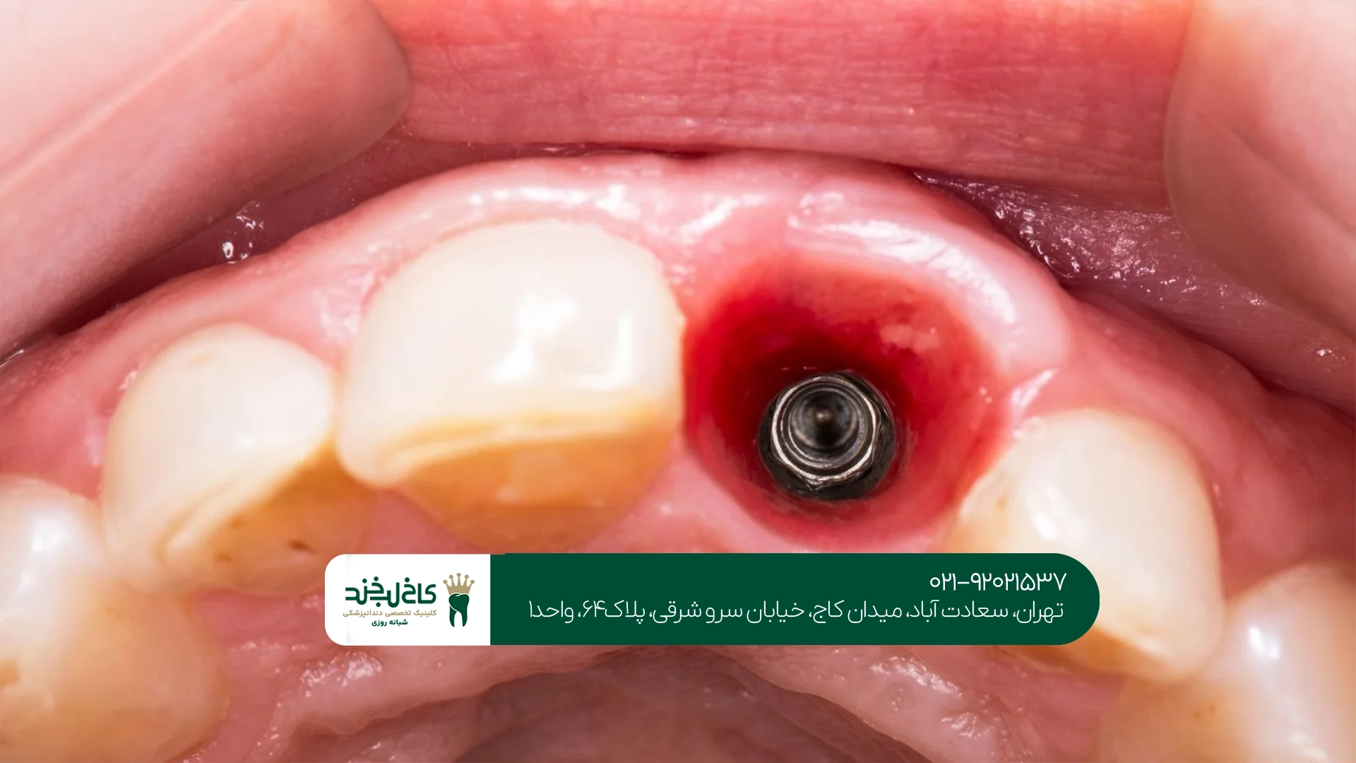 دکتر متخصص کاشت دندان