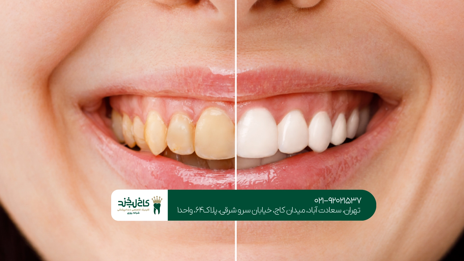 بهترین مرکز رفع زردی کامپوزیت بهترین مرکز رفع زردی کامپوزیت