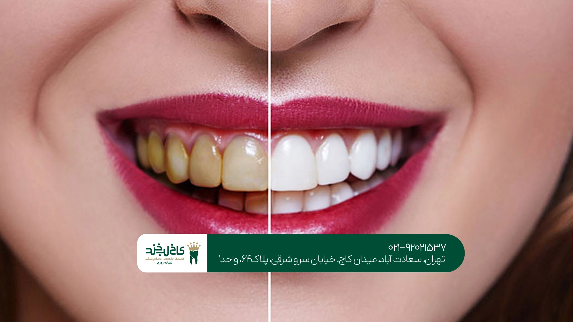 درمان زردی کامپوزیت دندان درمان زردی کامپوزیت دندان