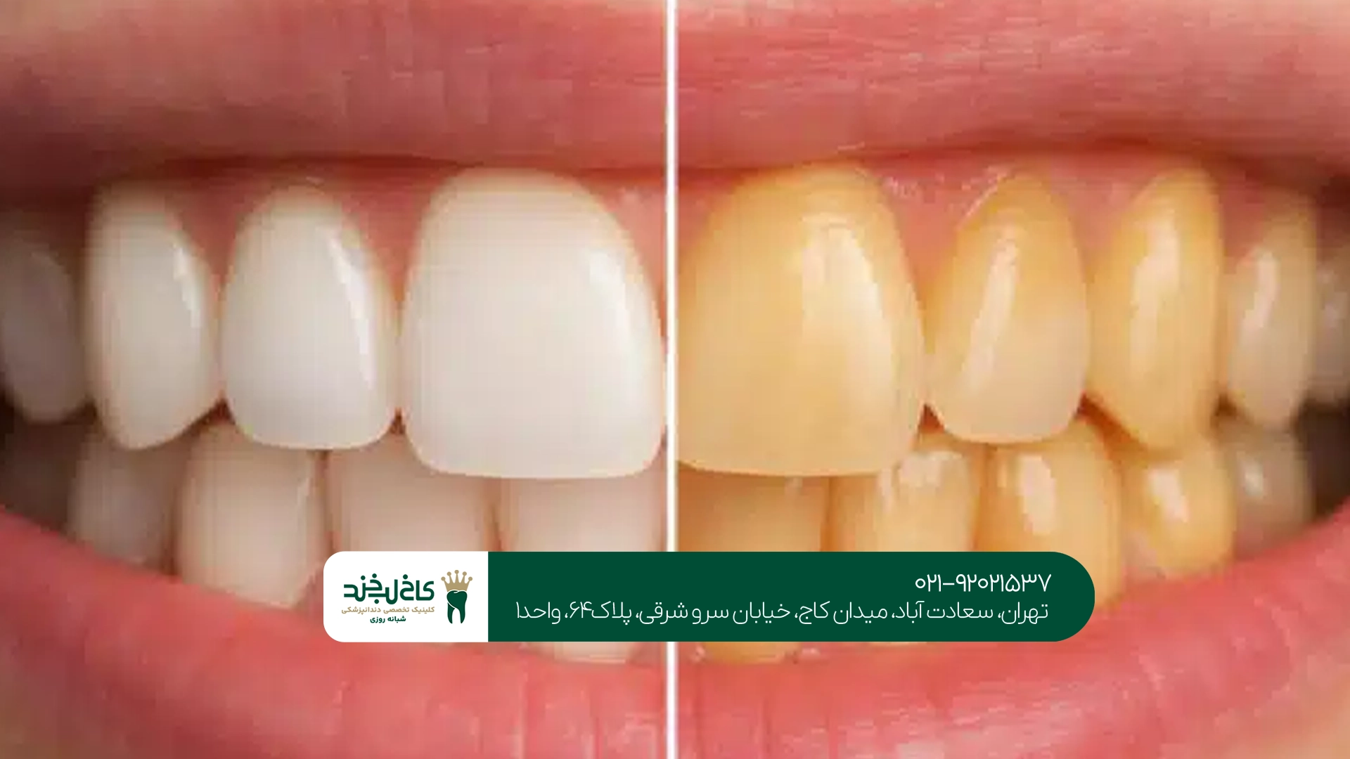 علت زرد شدن کامپوزیت دندان چیست؟ علت زرد شدن کامپوزیت دندان چیست؟