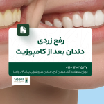 رفع زردی دندان بعد از کامپوزیت