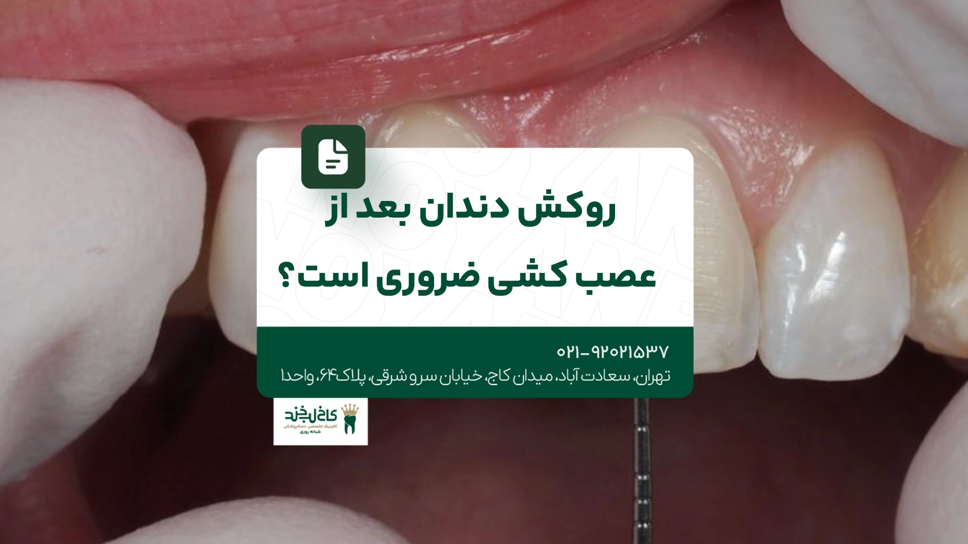 روکش دندان بعد از عصب کشی ضروری است؟