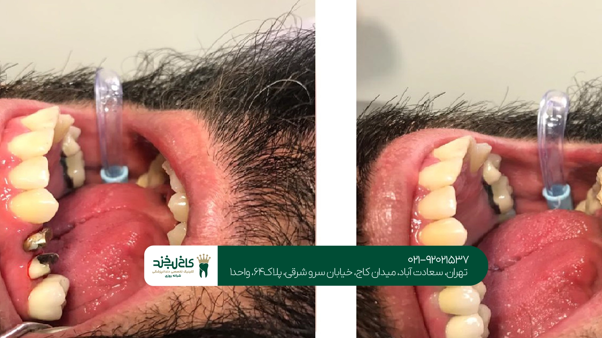 کلینیک روکش دندان بعد عصبکشی