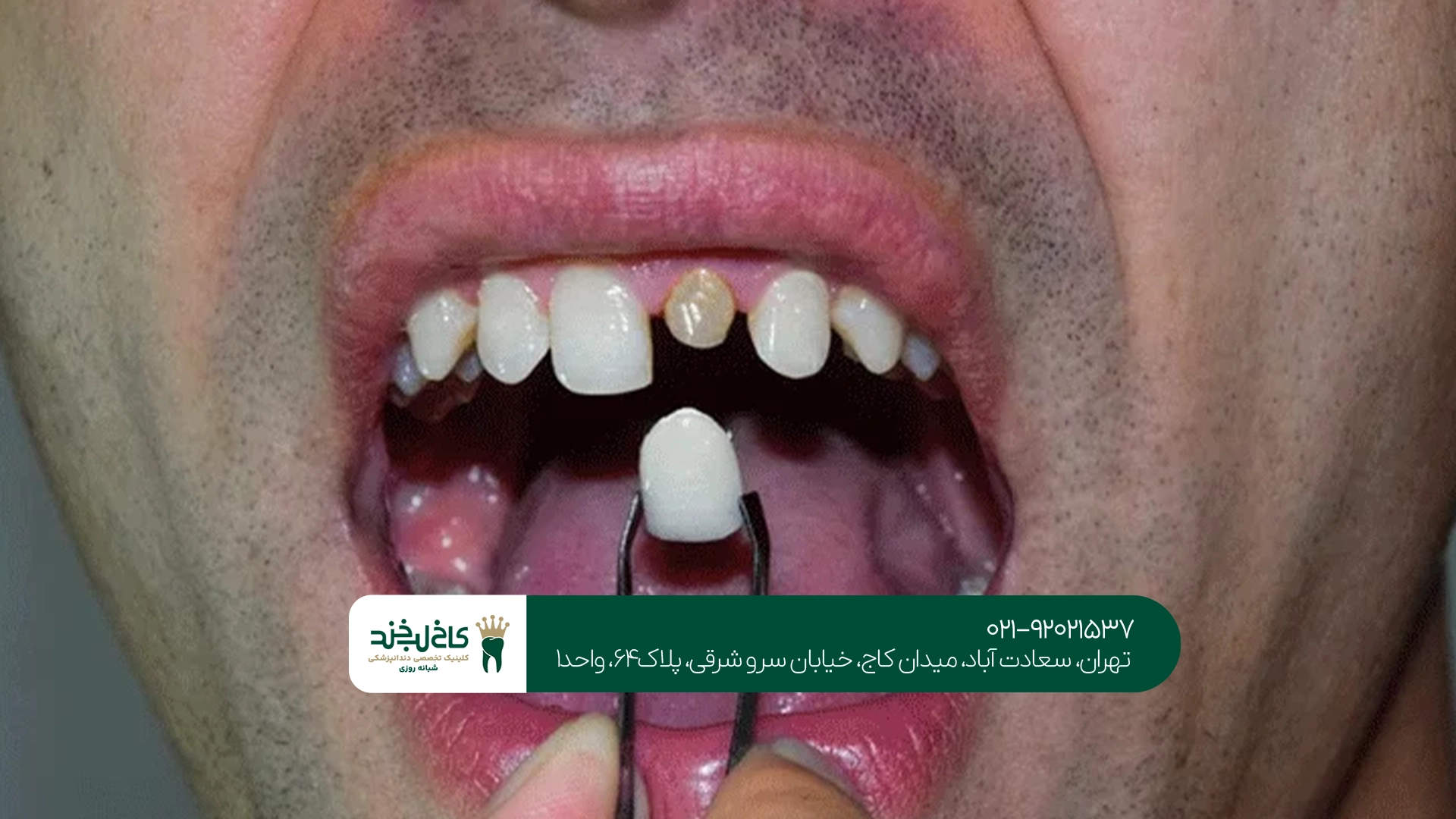 روکش دندان بعد از عصبکشی