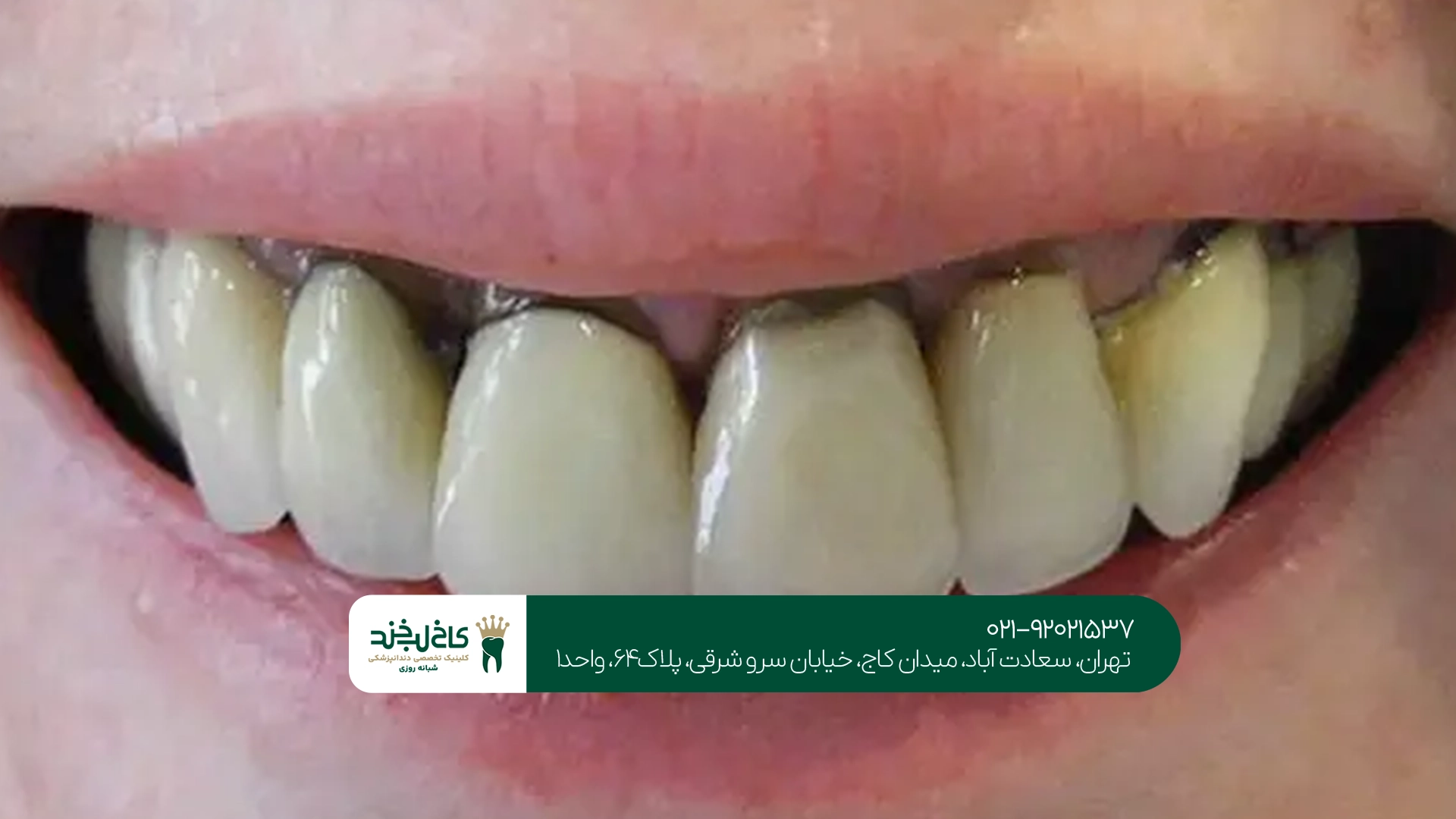 چه زمانی روکش دندان بعد از عصبکشی لازم است؟
