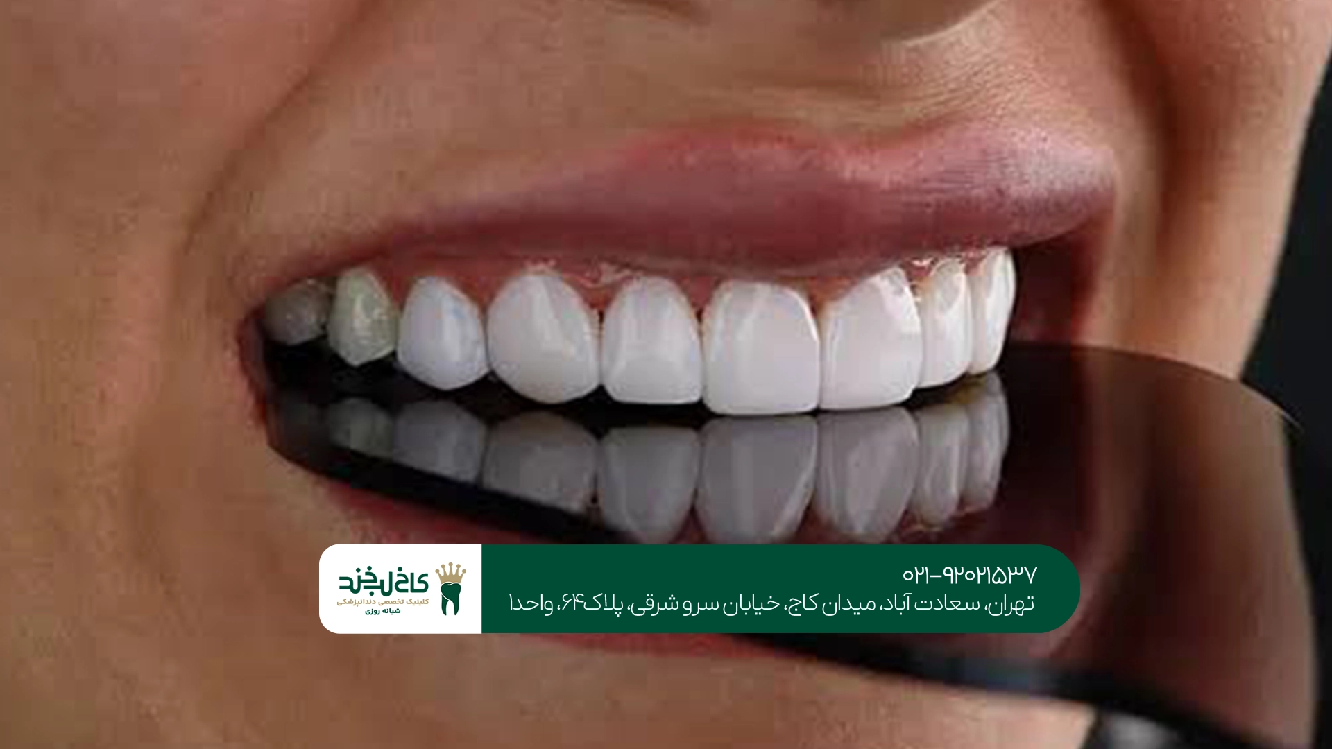 قیمت روکش دندان در سعادت آباد قیمت روکش دندان در سعادت آباد