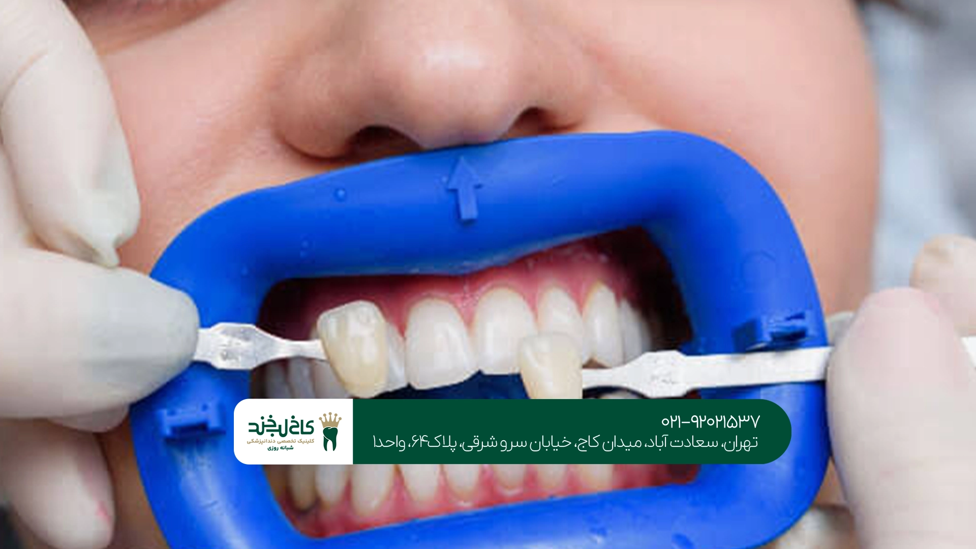 مراقبت بعد از روکش دندان مراقبت بعد از روکش دندان