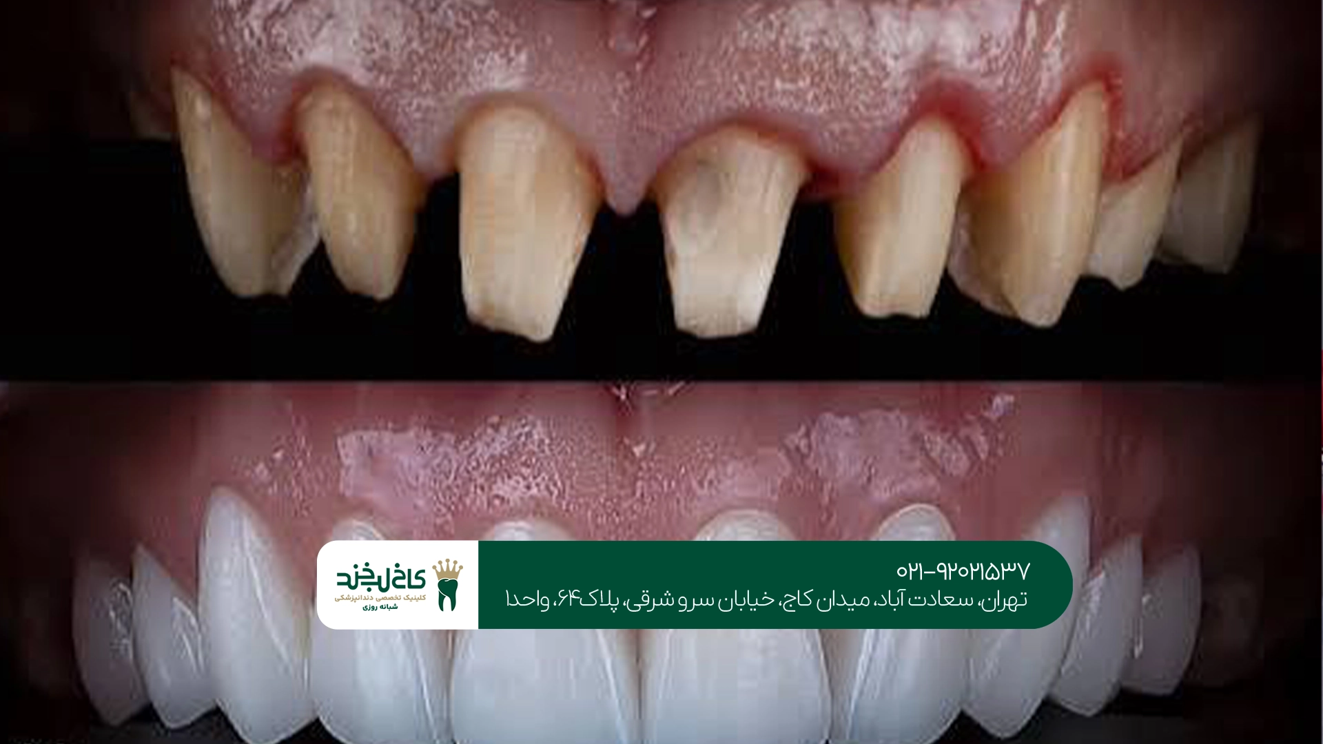 مراحل انجام روکش دندان مراحل انجام روکش دندان