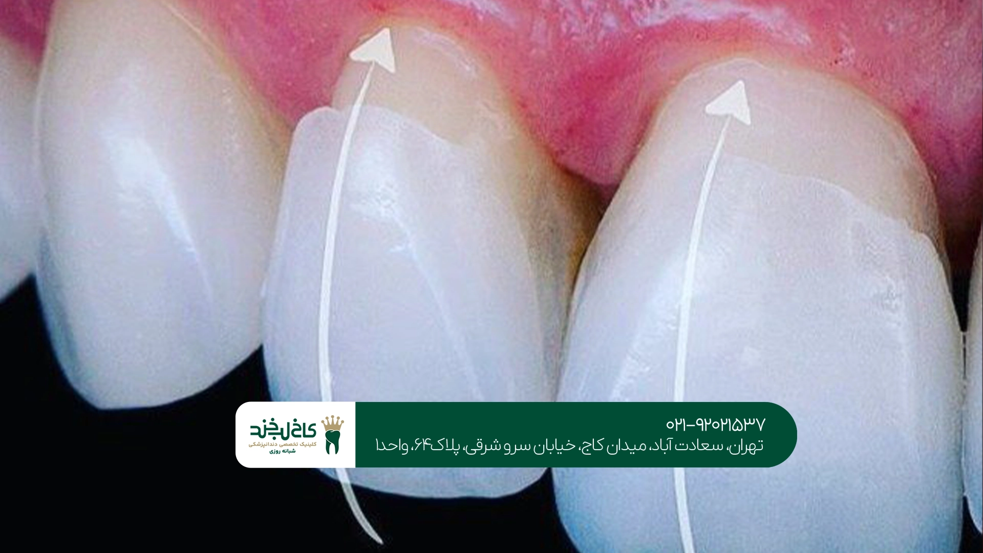 کلینیک روکش زیرکونیا