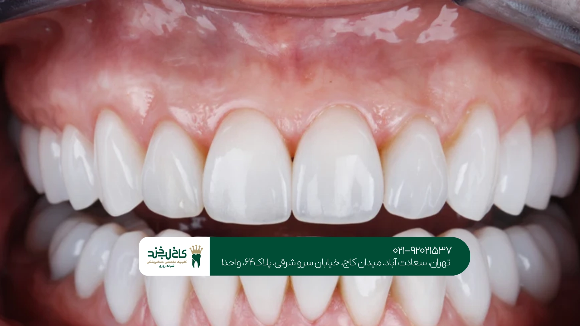 بهترین روکش زیرکونیا
