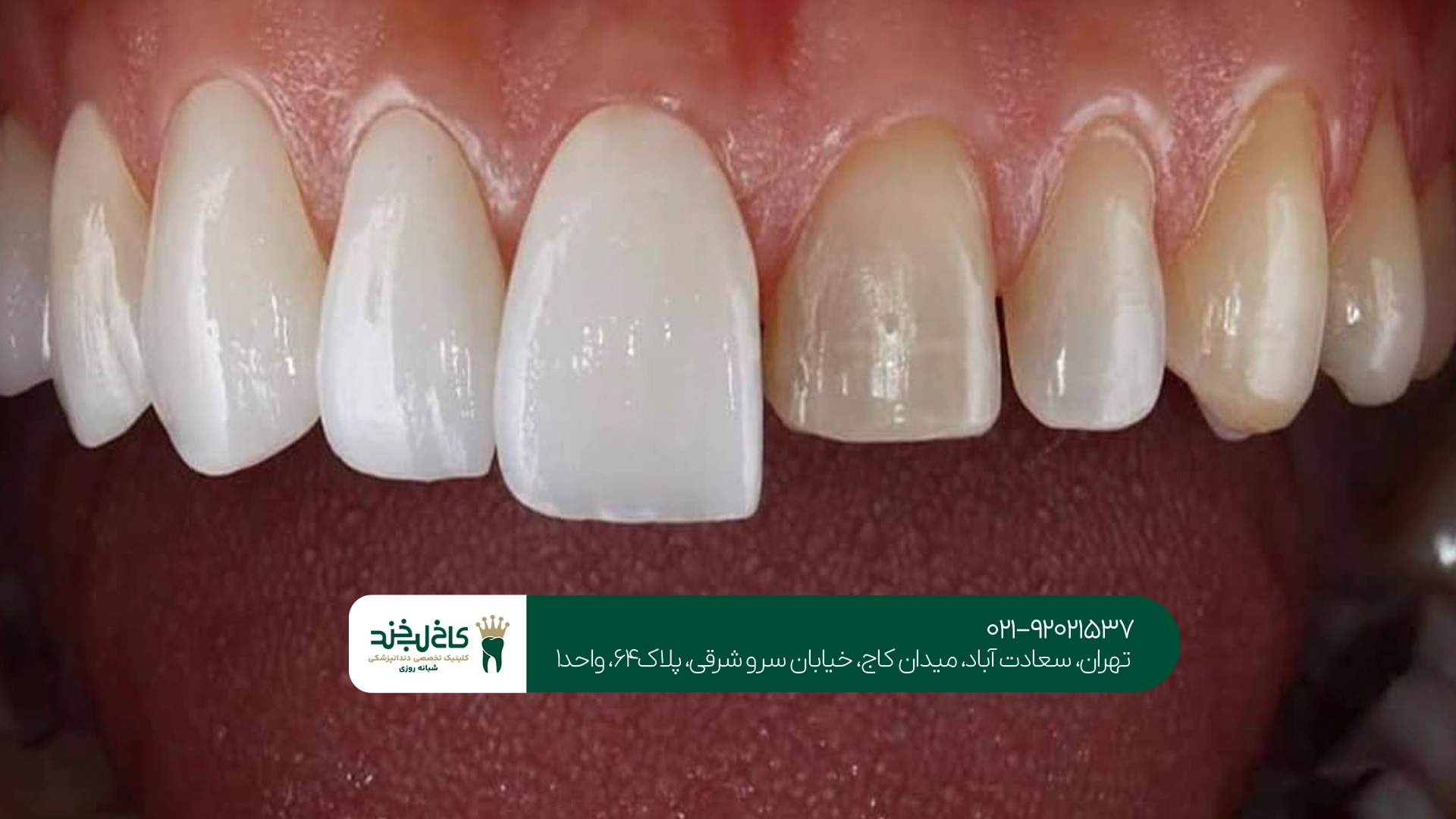 روکش زیرکونیا