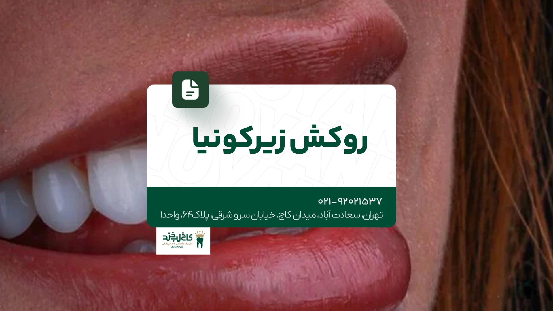 روکش زیرکونیا